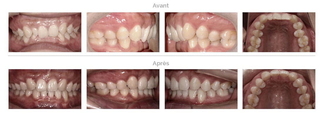 Traitement Invisalign deepbite à Bruxelles