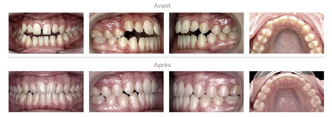 Traitement Invisalign d'espaces entre les dents