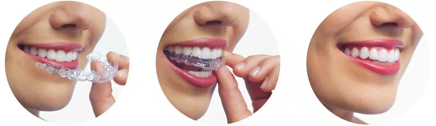 Orthodontist Brussel | iDent Clinic Specialist Orthodontie